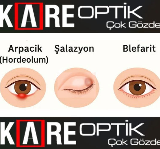 Arpacık Blefarit ve Şalozyon Arasındaki Farklar Neler ?