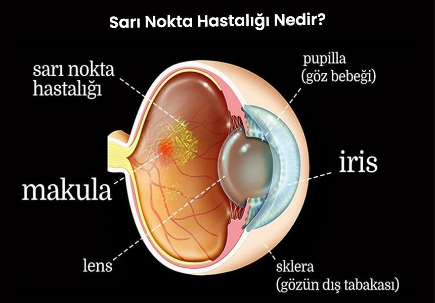 Sarı Nokta Hastalığı (AMD) Nedir ?
