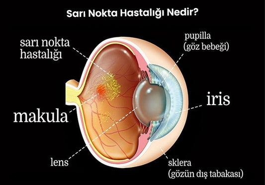 Sarı Nokta Hastalığı (AMD) Nedir ?