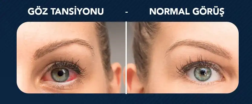 Glokom Göz Tansiyonu Nedir ?