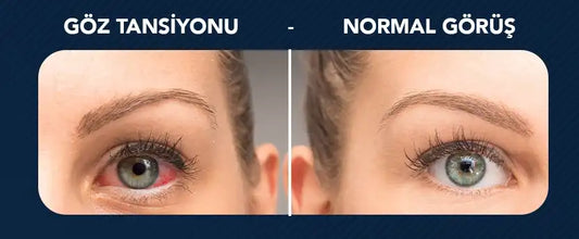 Glokom Göz Tansiyonu Nedir ?