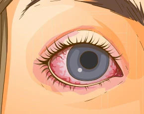 Konjonktivit Nedir ?