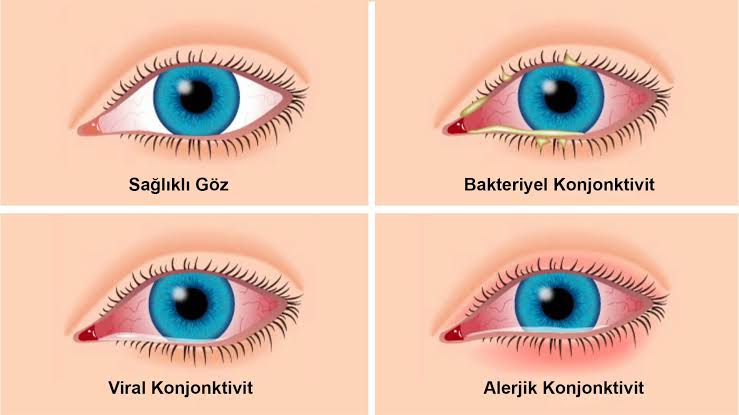 Göz Alerjileri