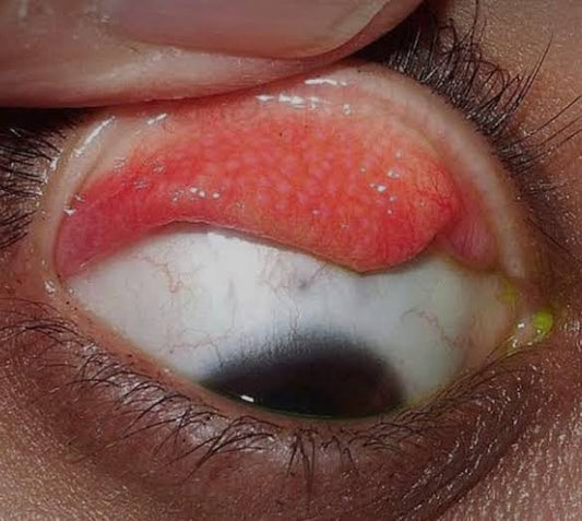 Dev Papiler Konjoktivit Nedir ?