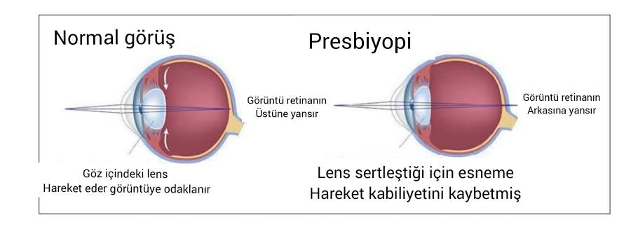 Yakını Görememe Presbiyobi Nedir ?