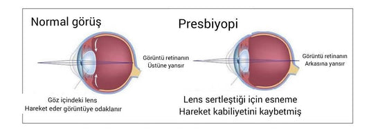Yakını Görememe Presbiyobi Nedir ?