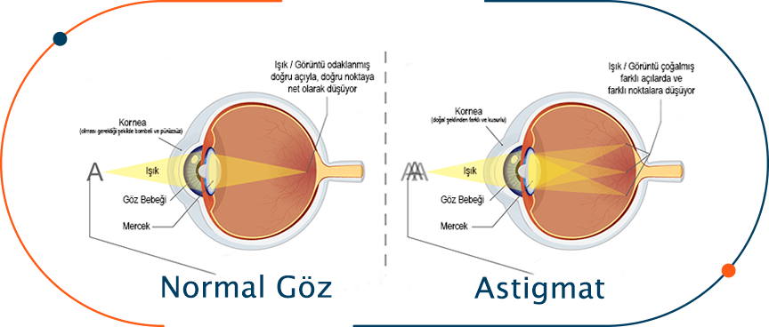 Bulanık Görme Astiğmat Nedir ?