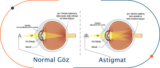 Bulanık Görme Astiğmat Nedir ?