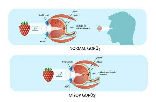 Uzağı Görememe Miyop Nedir ?