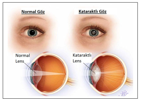 Katarakt Nedir ?